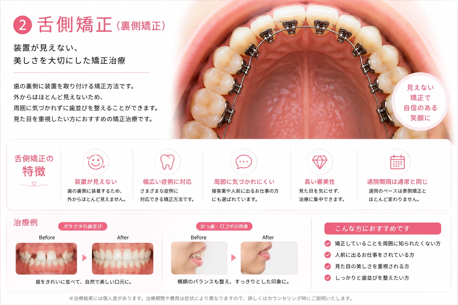 舌側矯正の特徴と治療例